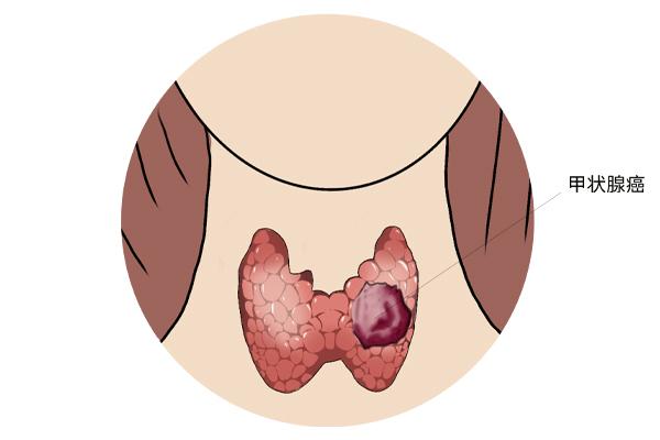 甲狀腺癌癥的主要癥狀表現有什么？為什么會得甲狀腺癌癥呢？