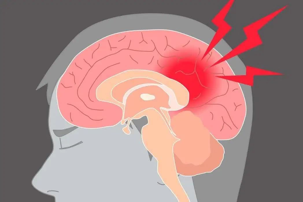 預(yù)防腦梗從習(xí)慣做起，這三大壞習(xí)慣，有的趕緊改正！